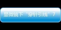 显微镜下“穿针引线”7小时！金湾这家医院成功帮患者保住断肢